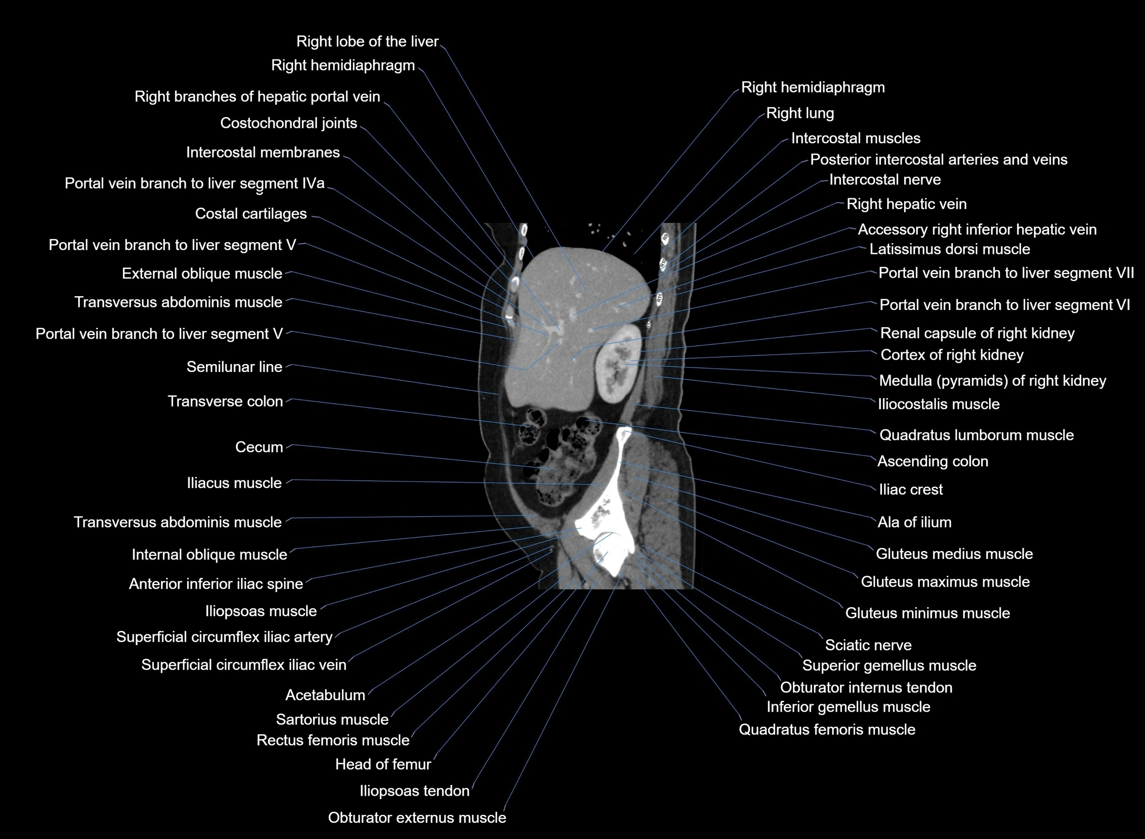 CT Abdomen sagittal cross sectional anatomy labelled radiology image -00086.webp